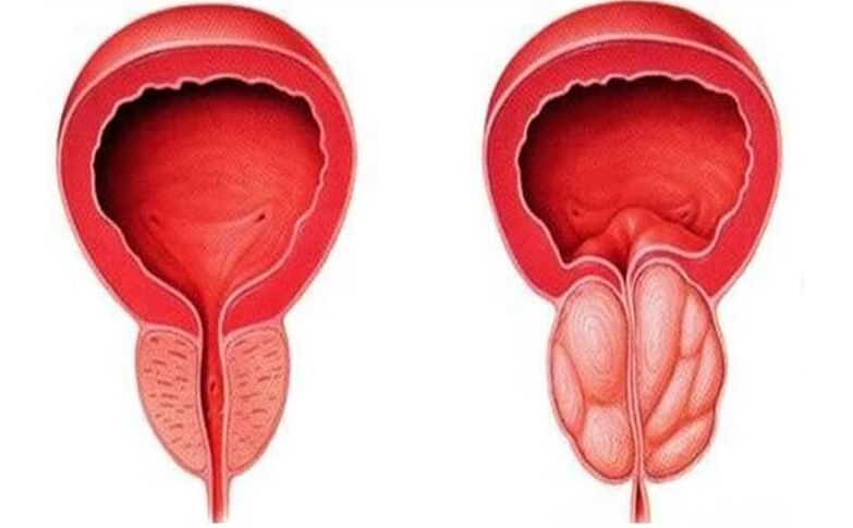 healthy prostate and inflamed with prostatitis