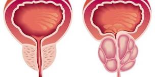 prostatitis