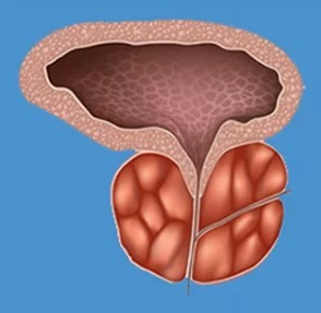 The characteristics of the prostatitis