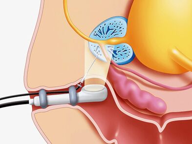 Prostate biopsy puncture