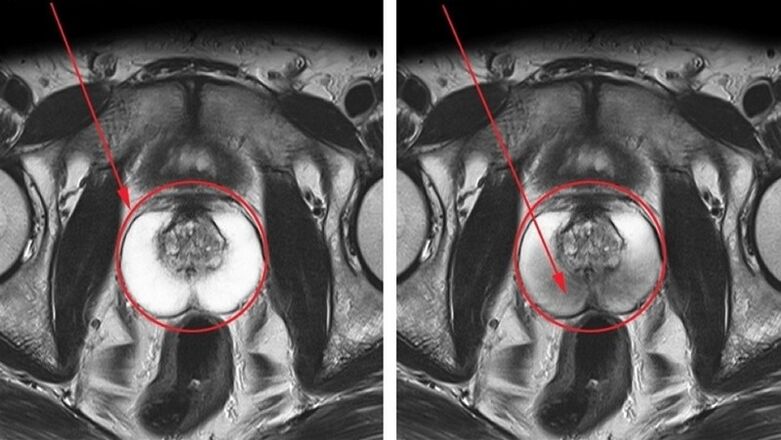 healthy and inflamed prostate with chronic prostatitis